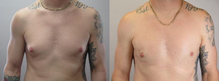 Gynecomastia Surgery Case 1671 Before & After Front | Paramus, New Jersey | Parker Center for Plastic Surgery