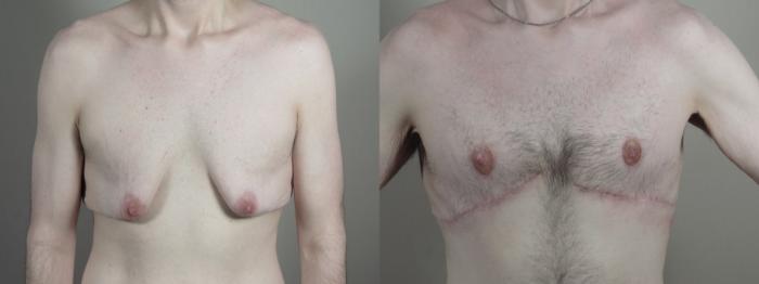 Abdominoplasty Case 1336 Before & After front view 2 | Paramus, New Jersey | Parker Center for Plastic Surgery