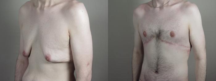 Abdominoplasty Case 1336 Before & After Left Oblique | Paramus, New Jersey | Parker Center for Plastic Surgery