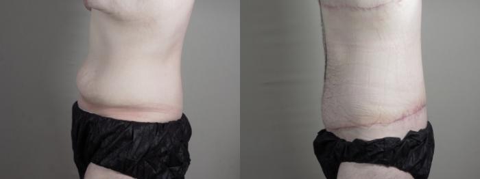 Abdominoplasty Case 1336 Before & After Left Side | Paramus, New Jersey | Parker Center for Plastic Surgery