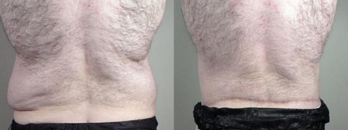 Abdominoplasty Case 1338 Before & After Back | Paramus, New Jersey | Parker Center for Plastic Surgery