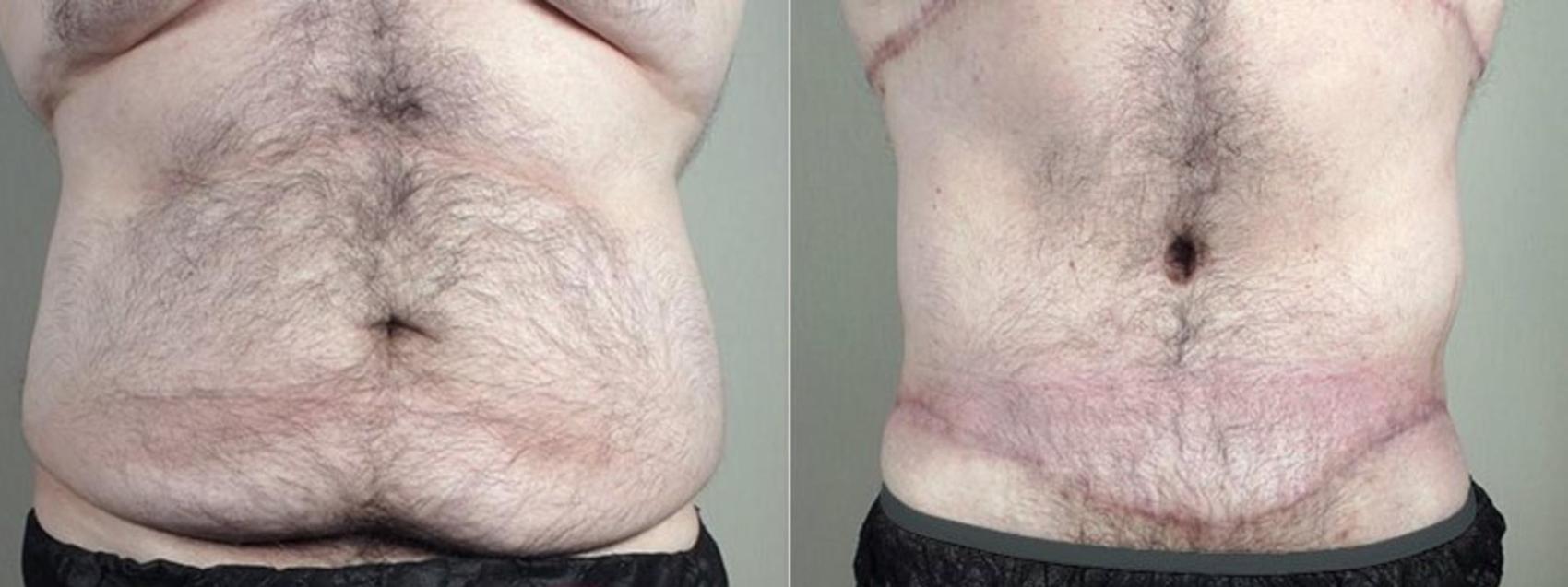 Abdominoplasty Case 1338 Before & After Front | Paramus, New Jersey | Parker Center for Plastic Surgery