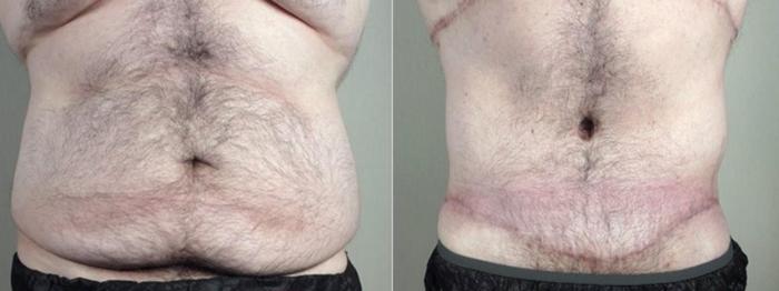 Abdominoplasty Case 1338 Before & After Front | Paramus, New Jersey | Parker Center for Plastic Surgery