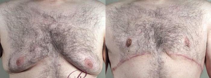 Abdominoplasty Case 1338 Before & After front view 2  | Paramus, New Jersey | Parker Center for Plastic Surgery