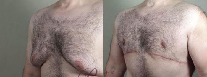 Abdominoplasty Case 1338 Before & After Left Oblique | Paramus, New Jersey | Parker Center for Plastic Surgery