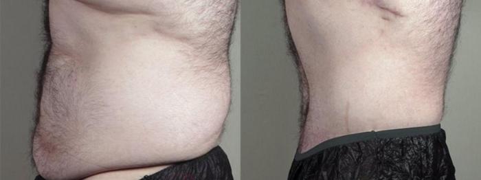 Abdominoplasty Case 1338 Before & After Left Side | Paramus, New Jersey | Parker Center for Plastic Surgery