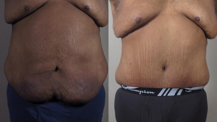 Abdominoplasty Case 1525 Before & After Front | Paramus, New Jersey | Parker Center for Plastic Surgery