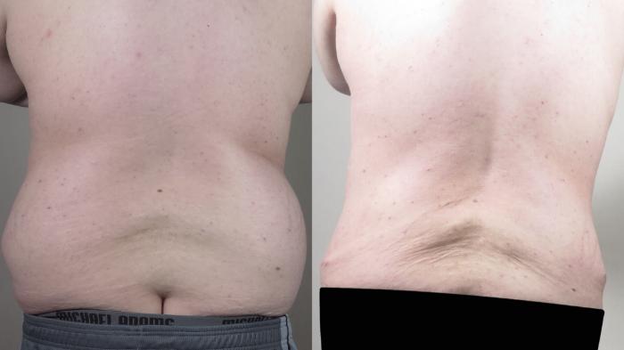 Abdominoplasty Case 1540 Before & After Back | Paramus, New Jersey | Parker Center for Plastic Surgery