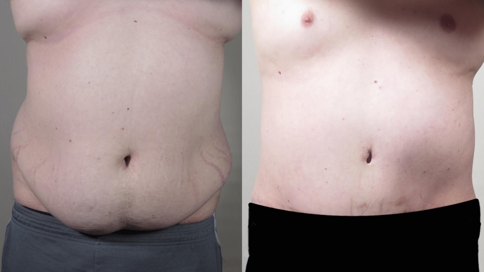 Abdominoplasty Case 1540 Before & After Front | Paramus, New Jersey | Parker Center for Plastic Surgery