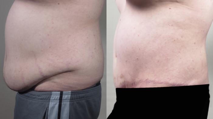 Abdominoplasty Case 1540 Before & After Left Side | Paramus, New Jersey | Parker Center for Plastic Surgery