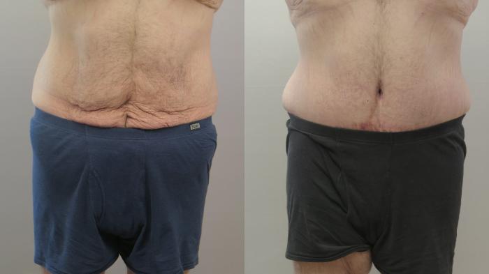 Abdominoplasty Case 1633 Before & After Front | Paramus, New Jersey | Parker Center for Plastic Surgery