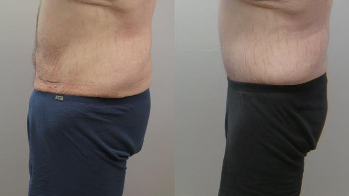 Abdominoplasty Case 1633 Before & After Left Side | Paramus, New Jersey | Parker Center for Plastic Surgery