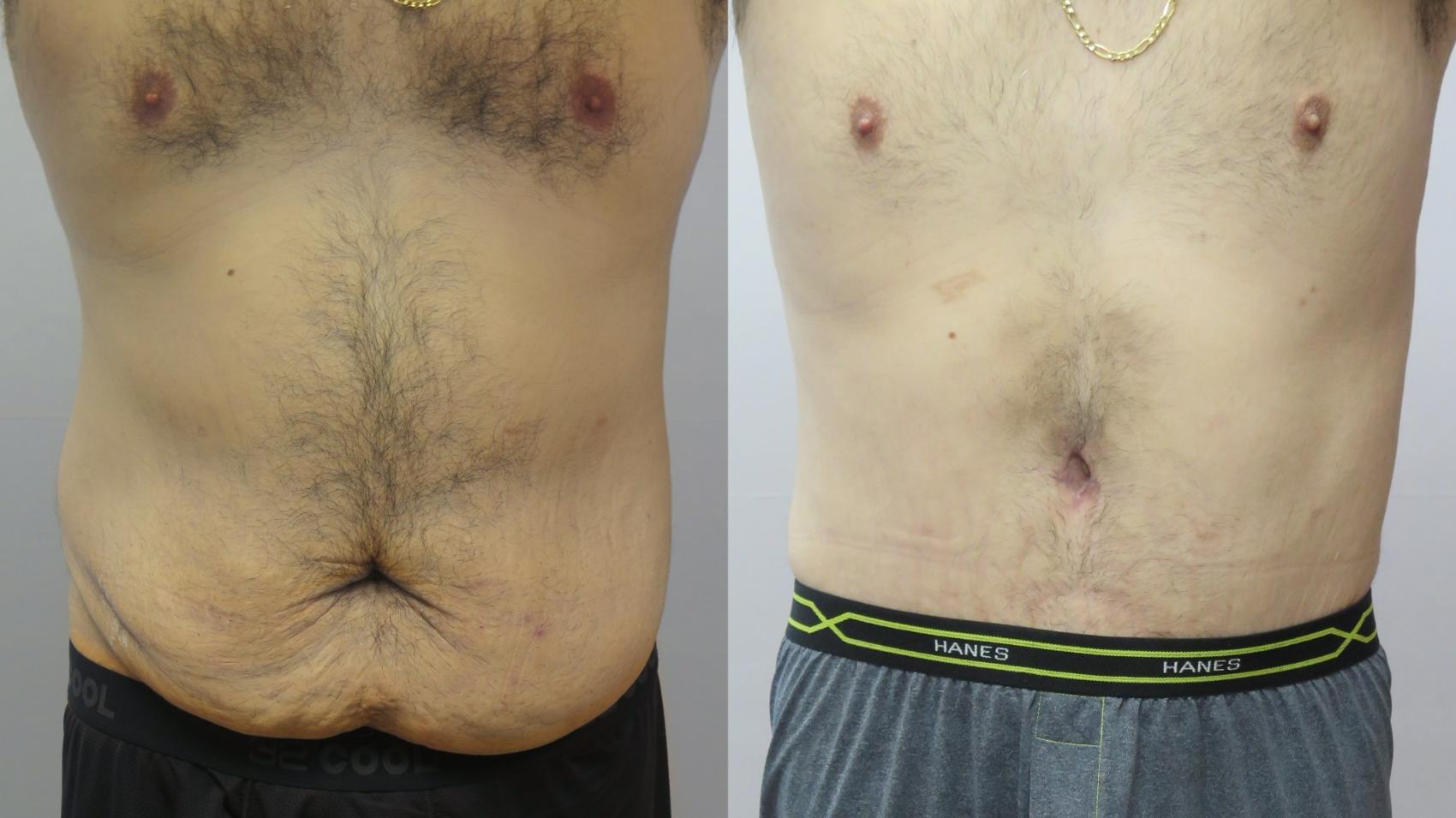 Abdominoplasty Case 1656 Before & After Front | Paramus, New Jersey | Parker Center for Plastic Surgery