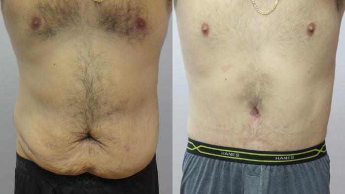 Abdominoplasty Case 1656 Before & After Front | Paramus, New Jersey | Parker Center for Plastic Surgery
