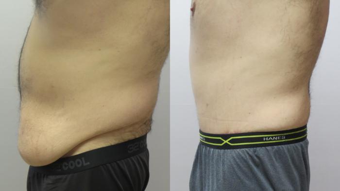 Abdominoplasty Case 1656 Before & After Right Side | Paramus, New Jersey | Parker Center for Plastic Surgery