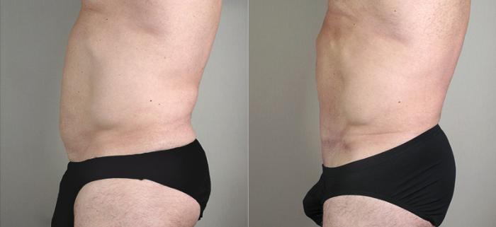 Abdominoplasty Case 641 Before & After View #2 | Paramus, New Jersey | Parker Center for Plastic Surgery