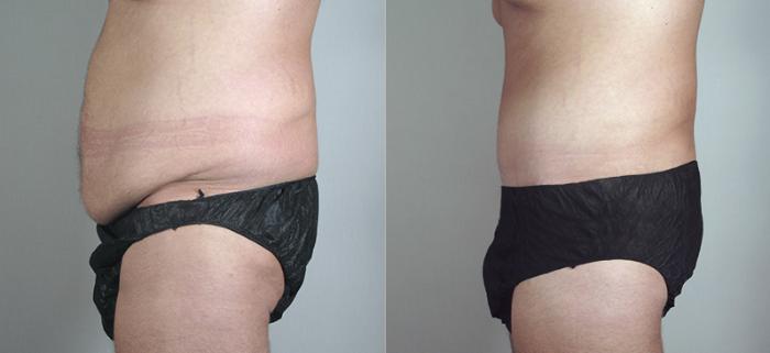 Abdominoplasty Case 681 Before & After View #2 | Paramus, New Jersey | Parker Center for Plastic Surgery