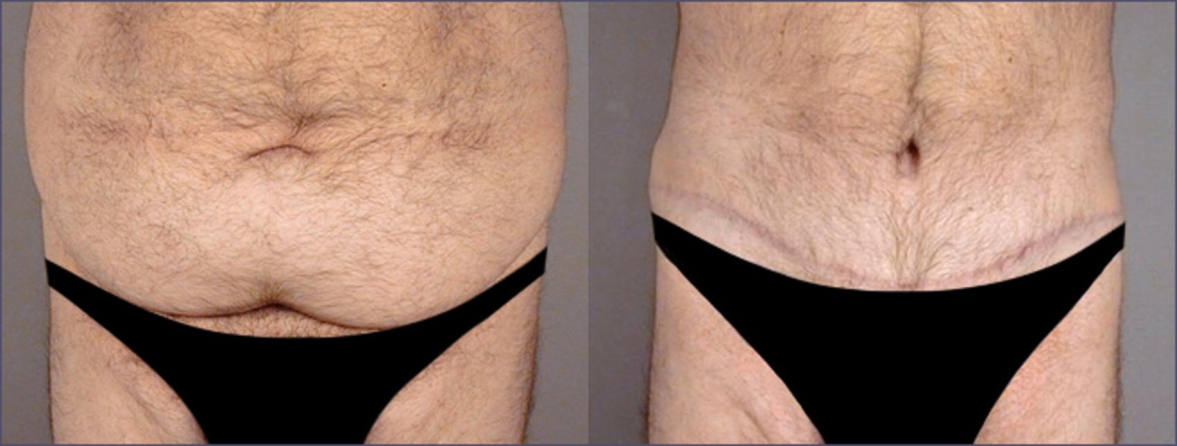Abdominoplasty Case 682 Before & After View #1 | Paramus, New Jersey | Parker Center for Plastic Surgery