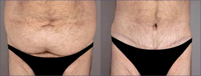 Abdominoplasty Case 682 Before & After View #1 | Paramus, New Jersey | Parker Center for Plastic Surgery