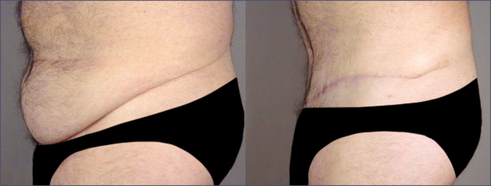 Abdominoplasty Case 682 Before & After View #2 | Paramus, New Jersey | Parker Center for Plastic Surgery