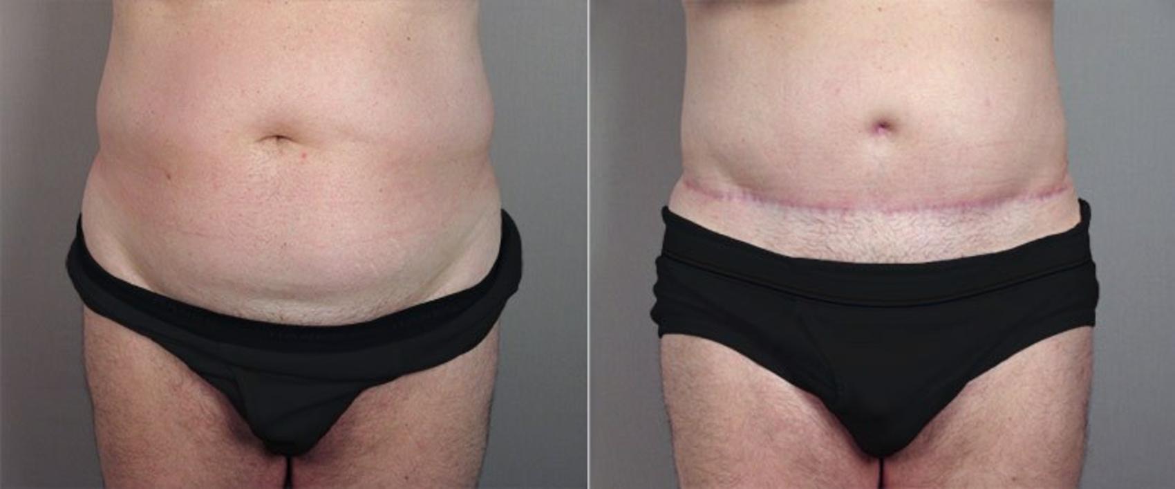 Abdominoplasty Case 683 Before & After View #1 | Paramus, New Jersey | Parker Center for Plastic Surgery