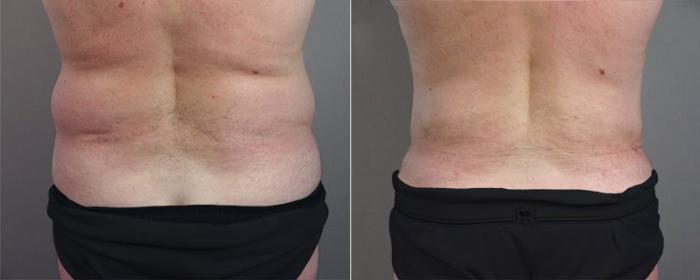 Abdominoplasty Case 683 Before & After View #2 | Paramus, New Jersey | Parker Center for Plastic Surgery