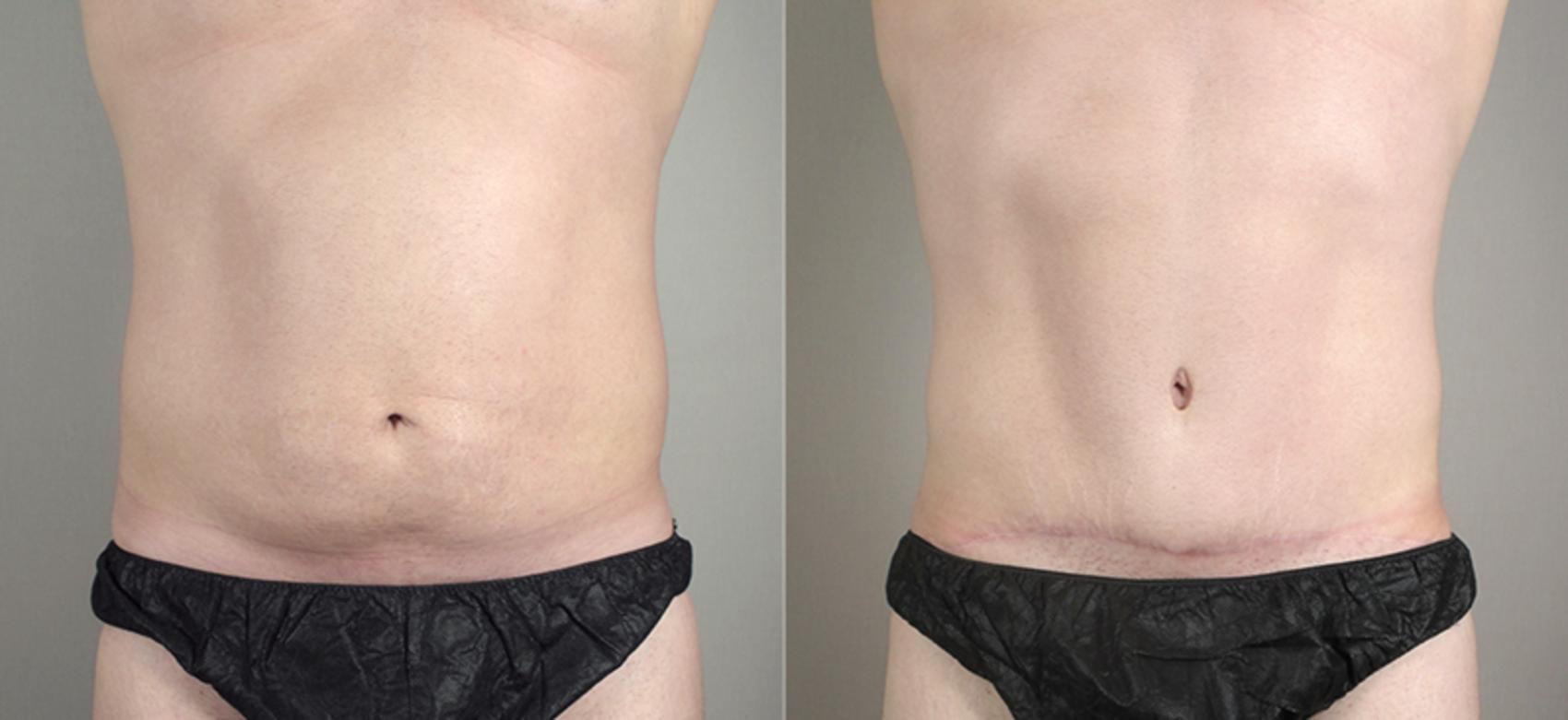 Abdominoplasty Case 713 Before & After View #1 | Paramus, New Jersey | Parker Center for Plastic Surgery