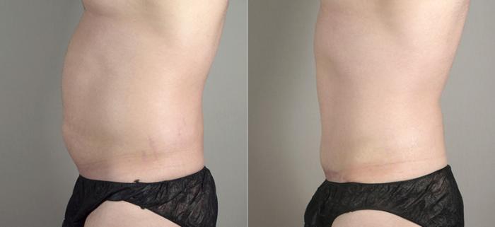 Abdominoplasty Case 713 Before & After View #2 | Paramus, New Jersey | Parker Center for Plastic Surgery