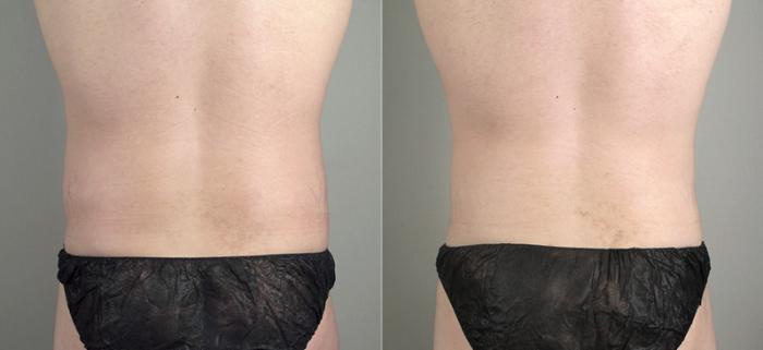 Abdominoplasty Case 713 Before & After View #3 | Paramus, New Jersey | Parker Center for Plastic Surgery