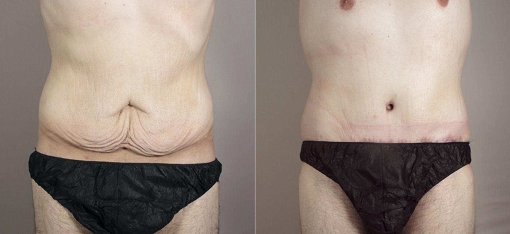 Abdominoplasty Case 716 Before & After View #1 | Paramus, New Jersey | Parker Center for Plastic Surgery