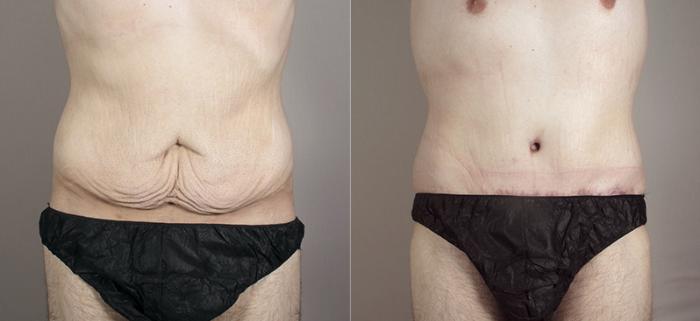 Abdominoplasty Case 716 Before & After View #1 | Paramus, New Jersey | Parker Center for Plastic Surgery