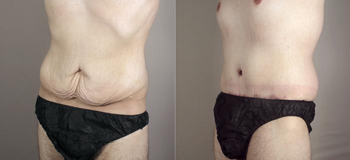Abdominoplasty Case 716 Before & After View #2 | Paramus, New Jersey | Parker Center for Plastic Surgery