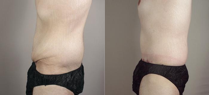 Abdominoplasty Case 716 Before & After View #3 | Paramus, New Jersey | Parker Center for Plastic Surgery