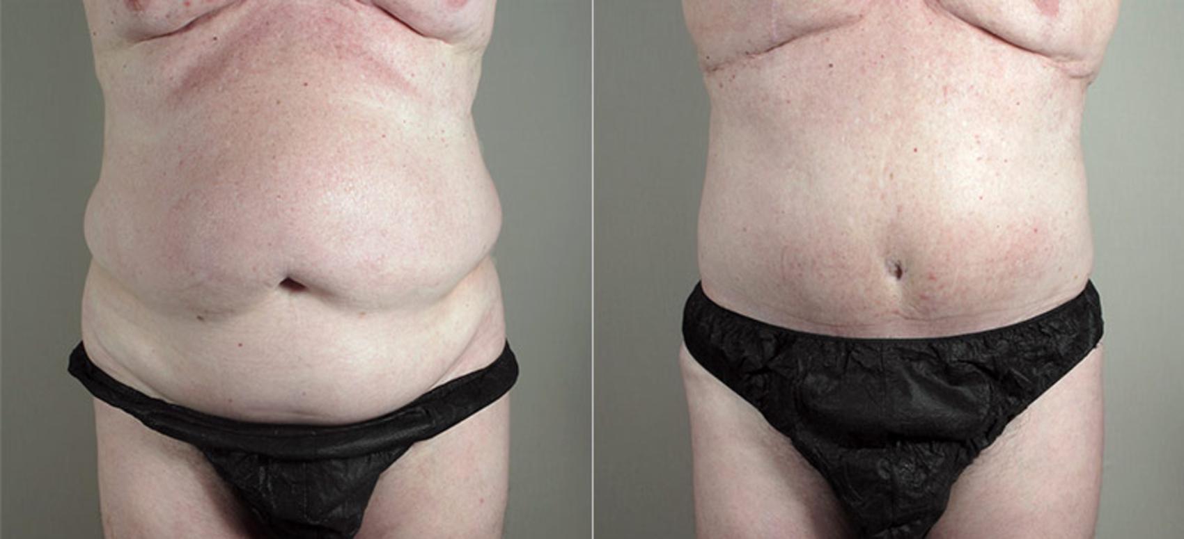 Abdominoplasty Case 723 Before & After View #1 | Paramus, New Jersey | Parker Center for Plastic Surgery