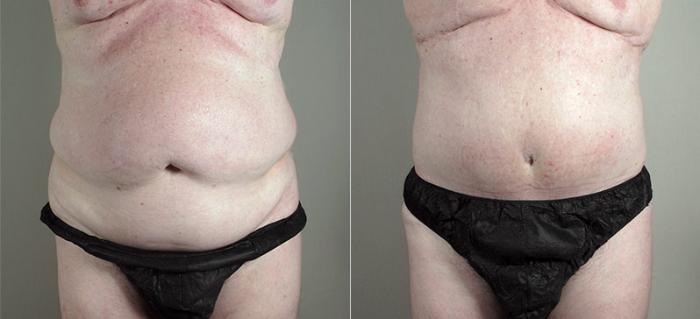 Abdominoplasty Case 723 Before & After View #1 | Paramus, New Jersey | Parker Center for Plastic Surgery