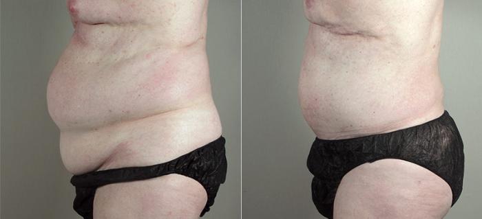 Abdominoplasty Case 723 Before & After View #2 | Paramus, New Jersey | Parker Center for Plastic Surgery