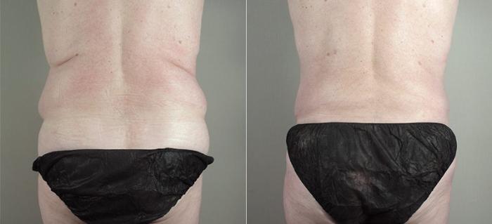 Abdominoplasty Case 723 Before & After View #3 | Paramus, New Jersey | Parker Center for Plastic Surgery