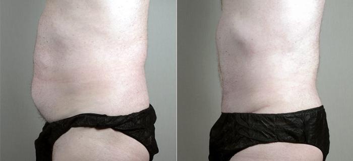 Abdominoplasty Case 725 Before & After View #2 | Paramus, New Jersey | Parker Center for Plastic Surgery