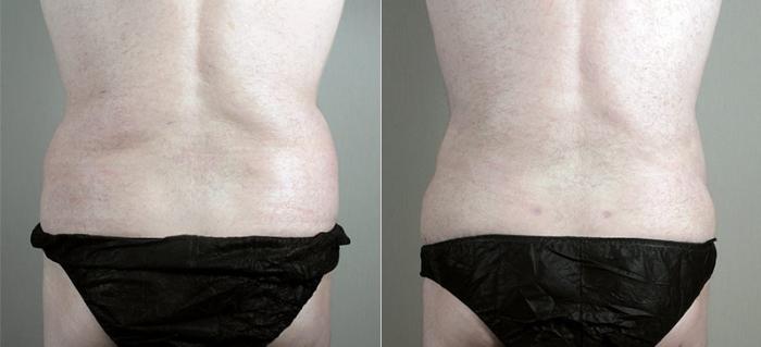 Abdominoplasty Case 725 Before & After View #3 | Paramus, New Jersey | Parker Center for Plastic Surgery