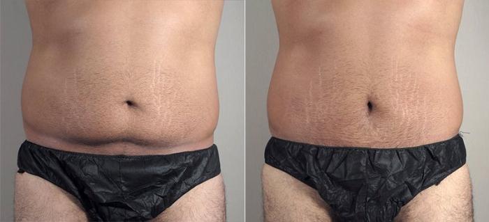 Abdominoplasty Case 736 Before & After View #1 | Paramus, New Jersey | Parker Center for Plastic Surgery