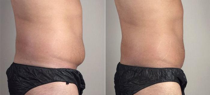 Abdominoplasty Case 736 Before & After View #2 | Paramus, New Jersey | Parker Center for Plastic Surgery