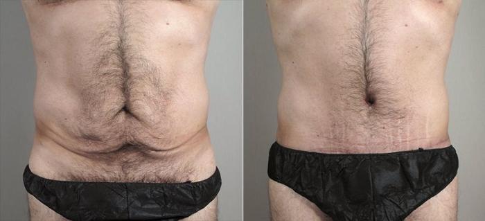 Abdominoplasty Case 737 Before & After View #1 | Paramus, New Jersey | Parker Center for Plastic Surgery