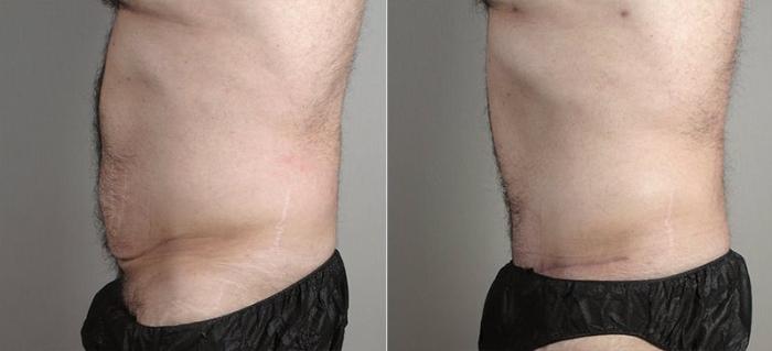 Abdominoplasty Case 737 Before & After View #2 | Paramus, New Jersey | Parker Center for Plastic Surgery
