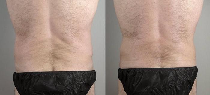 Abdominoplasty Case 737 Before & After View #3 | Paramus, New Jersey | Parker Center for Plastic Surgery