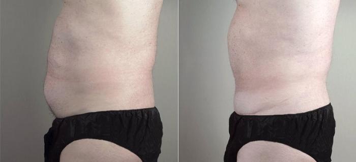 Abdominoplasty Case 738 Before & After View #2 | Paramus, New Jersey | Parker Center for Plastic Surgery