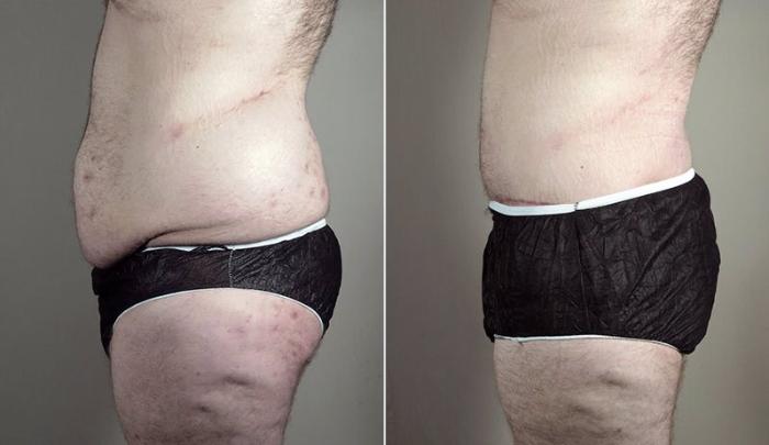 Abdominoplasty Case 743 Before & After View #2 | Paramus, New Jersey | Parker Center for Plastic Surgery