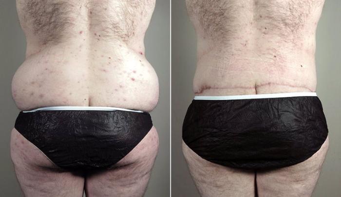Abdominoplasty Case 743 Before & After View #3 | Paramus, New Jersey | Parker Center for Plastic Surgery