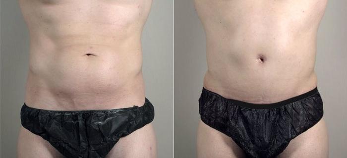 Abdominoplasty Case 746 Before & After View #1 | Paramus, New Jersey | Parker Center for Plastic Surgery
