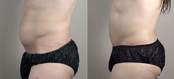 Abdominoplasty Case 746 Before & After View #2 | Paramus, New Jersey | Parker Center for Plastic Surgery