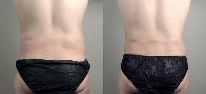 Abdominoplasty Case 746 Before & After View #3 | Paramus, New Jersey | Parker Center for Plastic Surgery